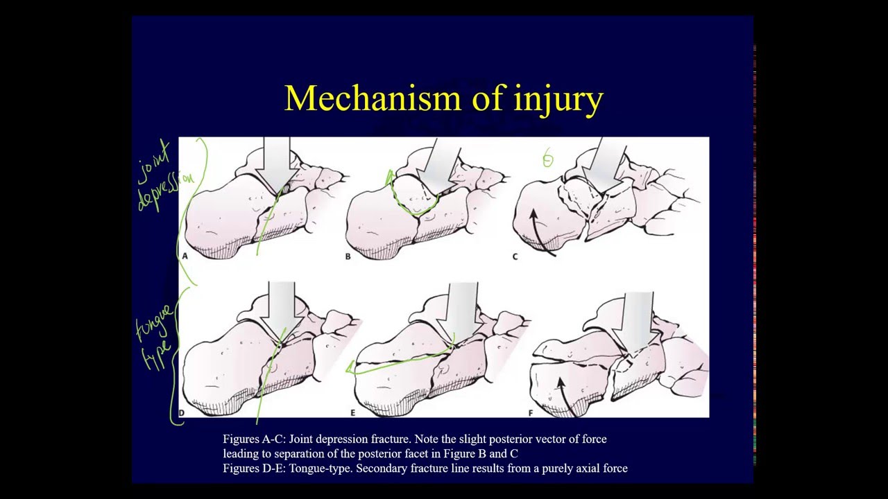 Calcaneal fractures - Anatomy, evaluation, classification (OTA lecture series IV L15a)