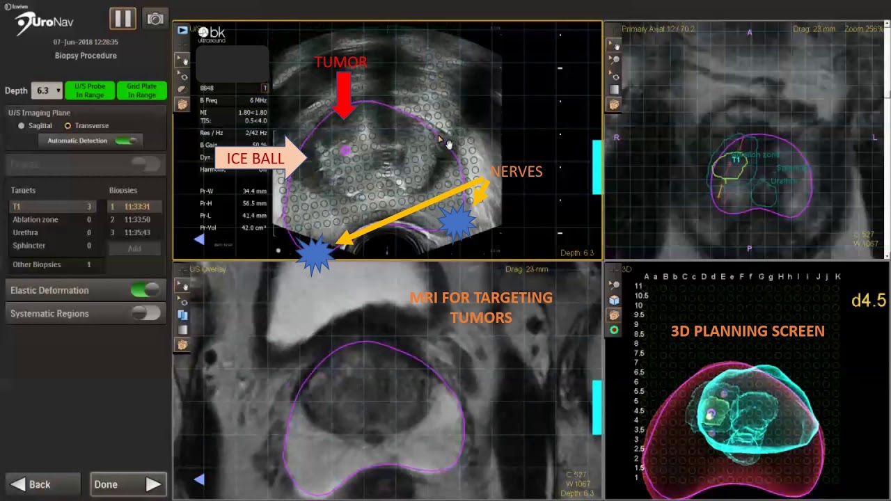 Focal Prostate Cancer Cryoablation using MR US fusion guidance (UroNav)