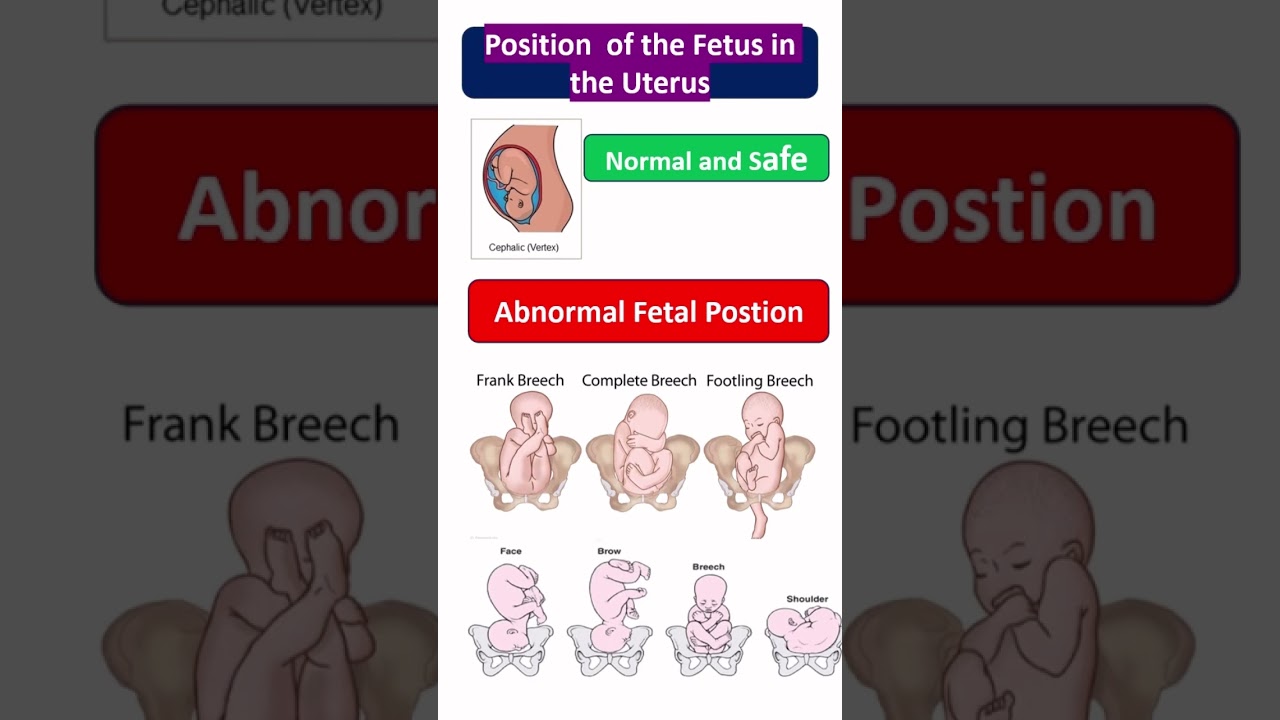Normal & Abnormal Fetal Positions Explained | Pregnancy Awareness , #Shorts # You tube shorts
