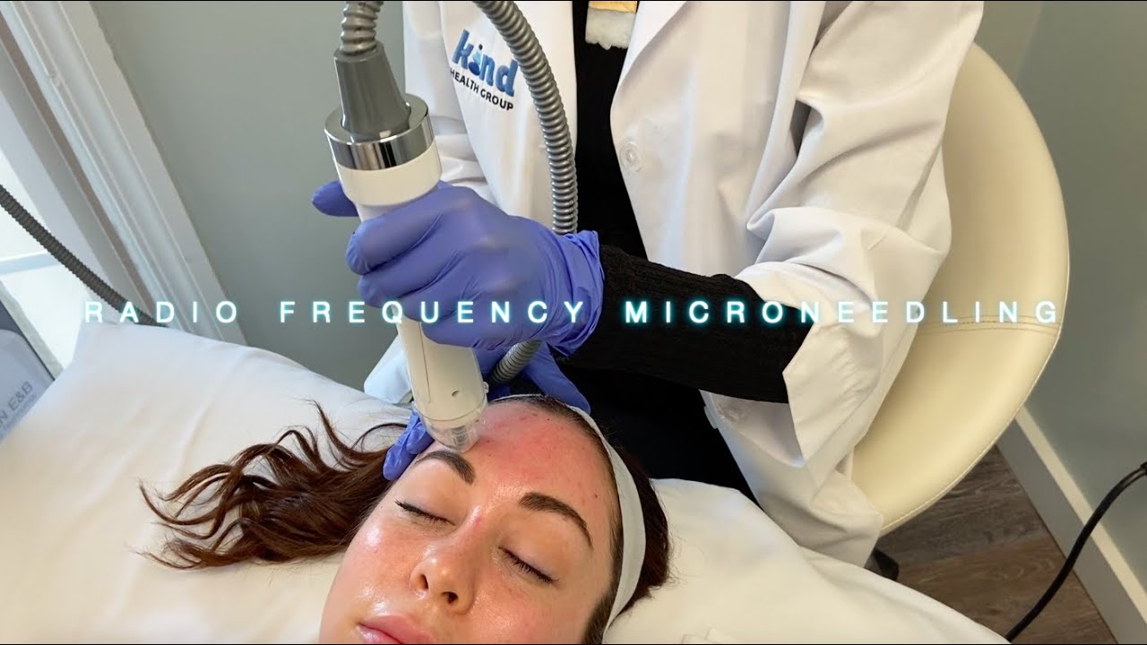 RF Microneedling at Kind Health Group