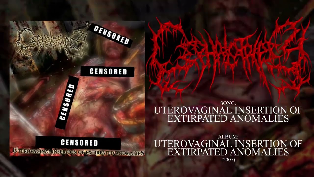 CEPHALOTRIPSY- Uterovaginal Insertion Of Extirpated Anomalies