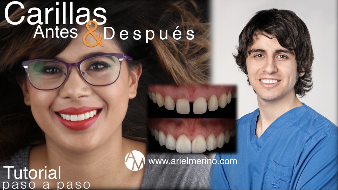 TRANSFORMACIÓN BRUTAL de Sonrisa con Carillas Dentales | Dr. Ariel Merino | Antes y Después