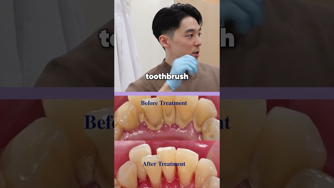What happens if you don't floss correctly? [Common dental myths]
