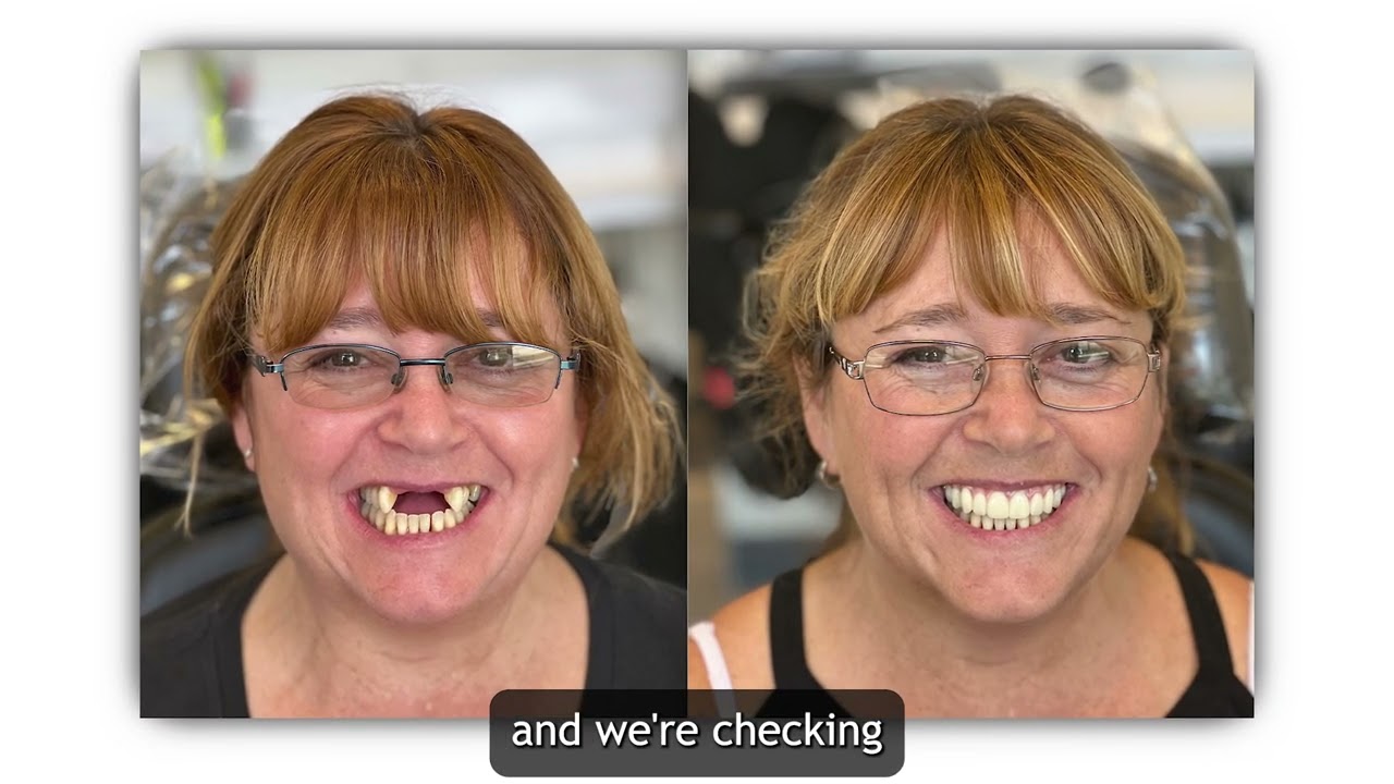 Dr. Rich answers some common dental implant questions!