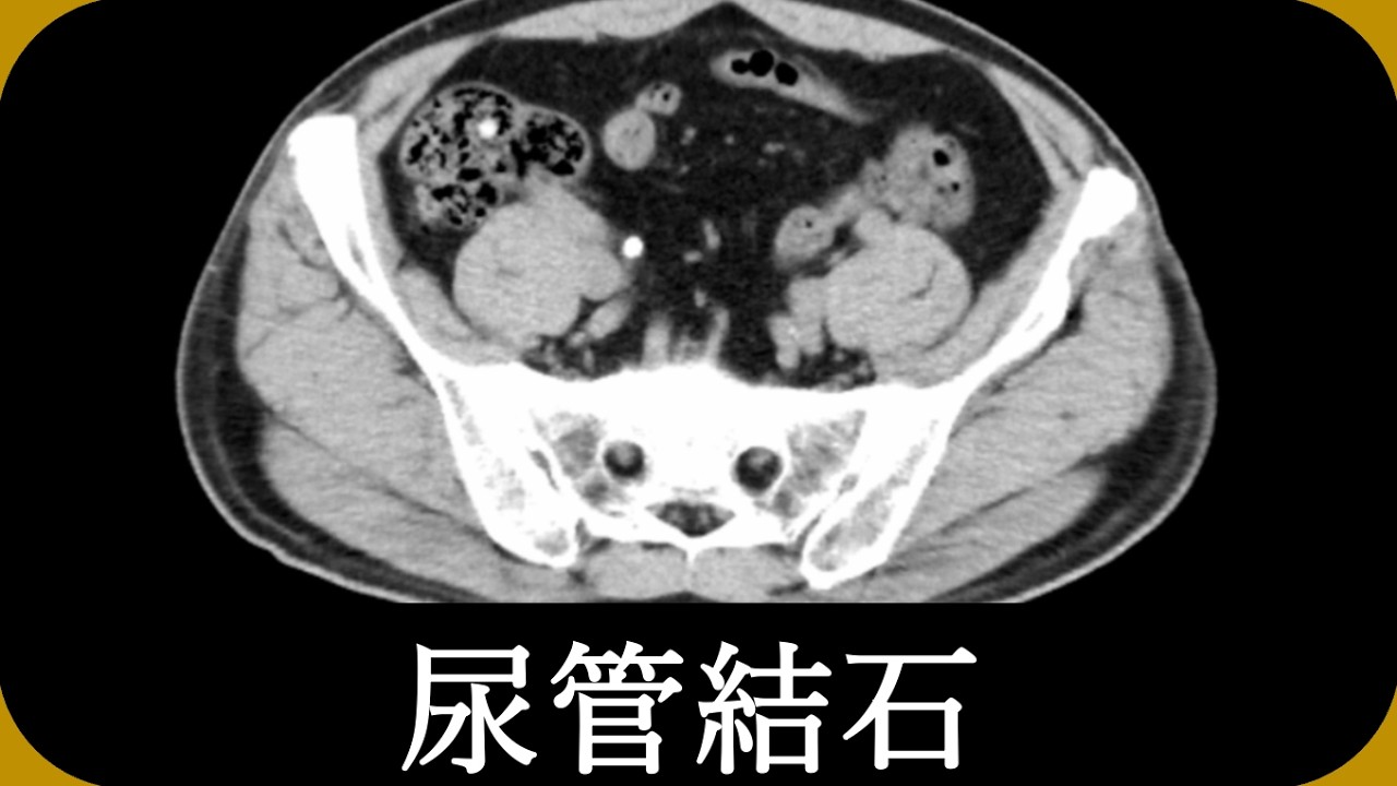 尿管結石の画像診断（CT/MRI）
