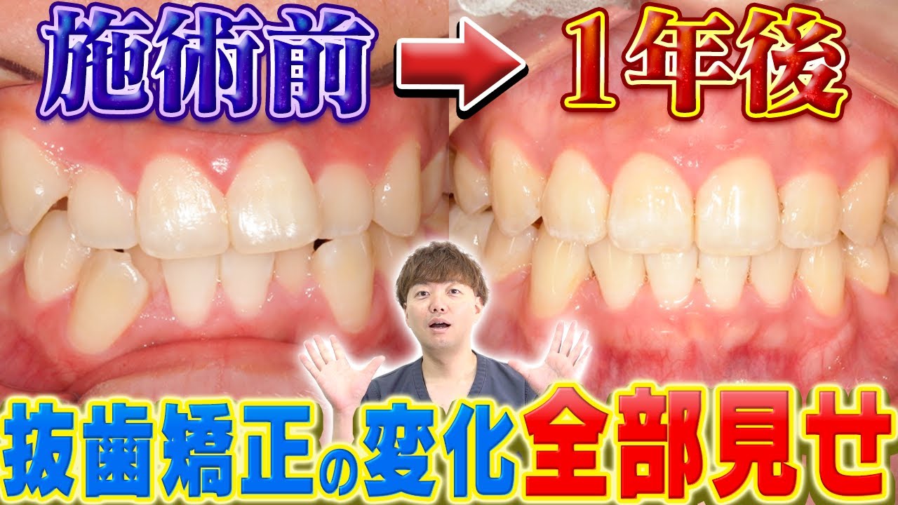 【マウスピース矯正ビフォーアフター】1年でここまで変わる!抜歯ありでも理想の横顔に/相武台歯科スマーティー症例解説