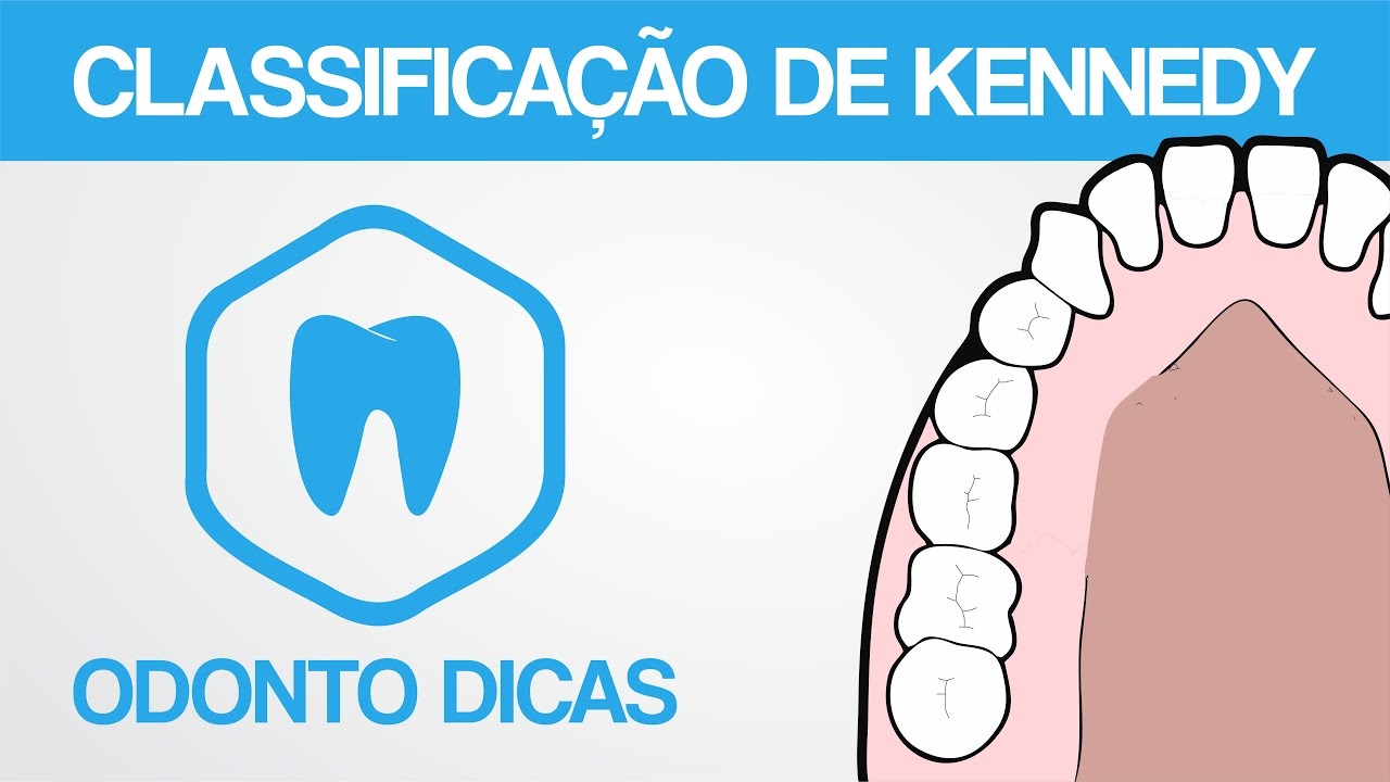 CLASSIFICAÇÃO DE KENNEDY & REGRAS DE APPLEGATE | ODONTO DICAS