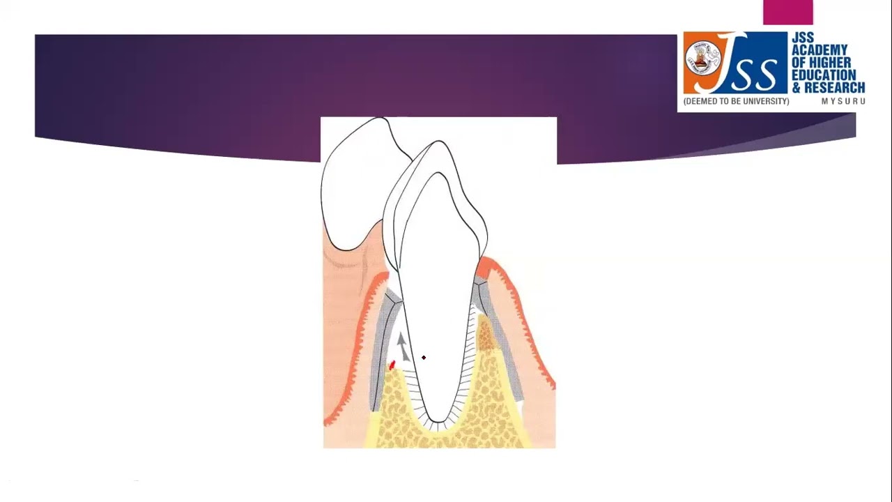 Regenerative Periodontal Surgery