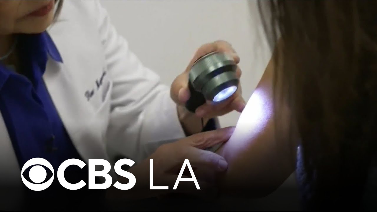 Moderna says melanoma vaccine trial shows 
