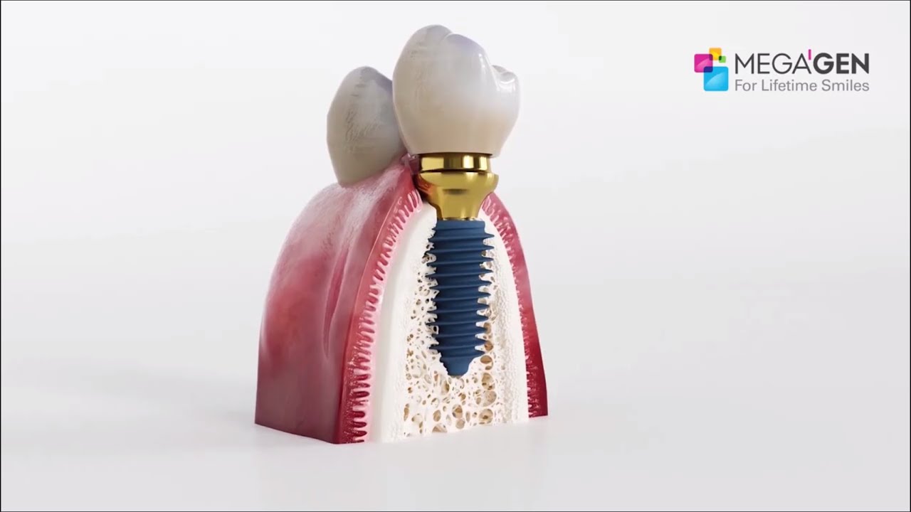 MegaGen - THE AnyRidge Implant