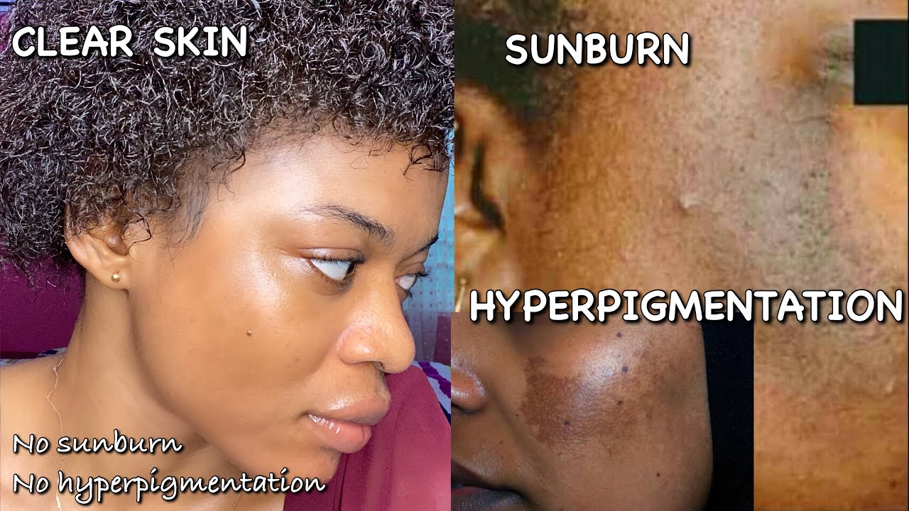 The difference between SUNBURN and HYPERPIGMENTATION, the CONFUSION | Detailed | *A MUST WATCH*