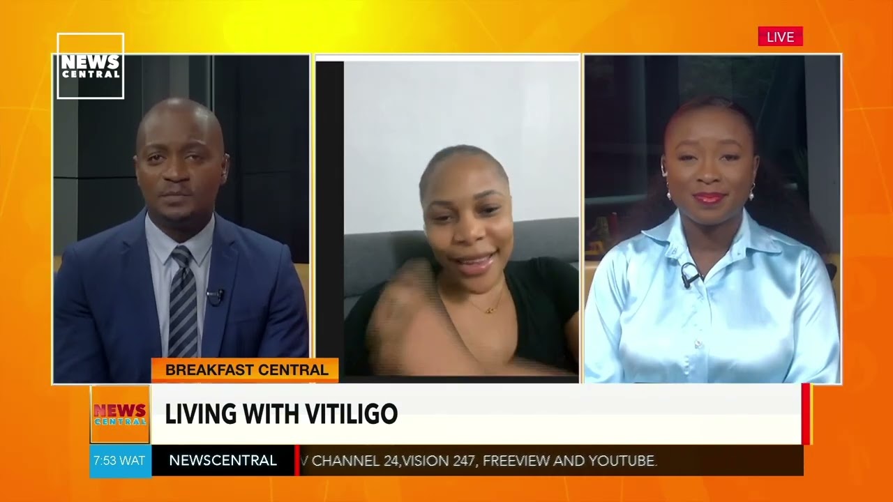 Temilola Omoobajesu on Living with Vitiligo