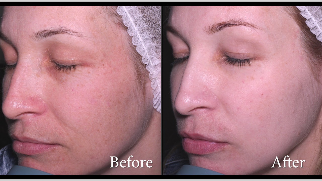 Brown Dermatology Phenol and Croton Oil Deep Chemical Peels