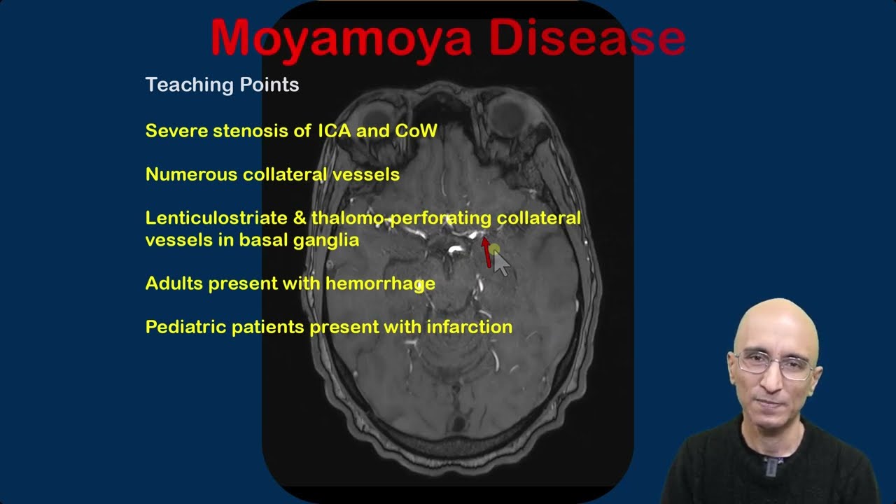 Moyamoya Disease