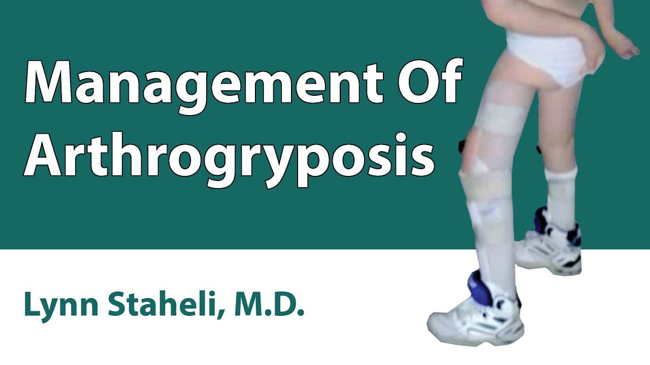 Management Of Arthrogryposis