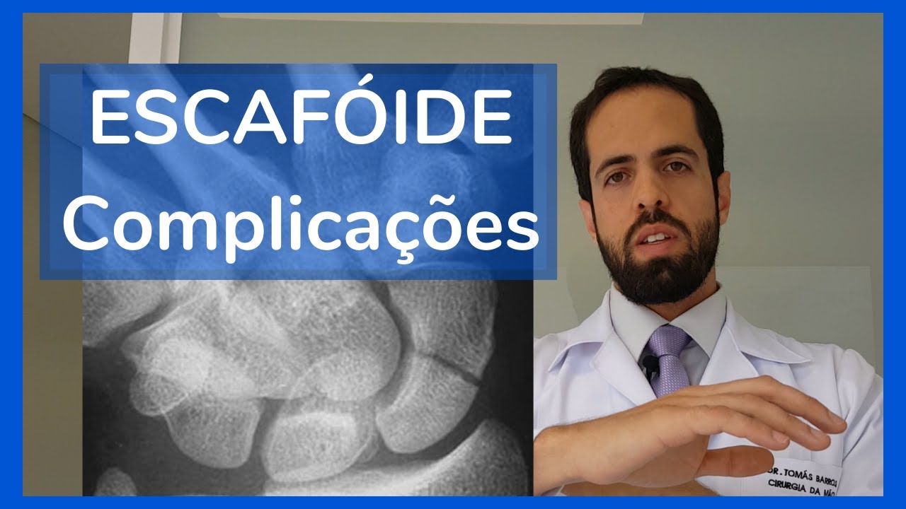 Por que o Escafóide dá tanto problema?