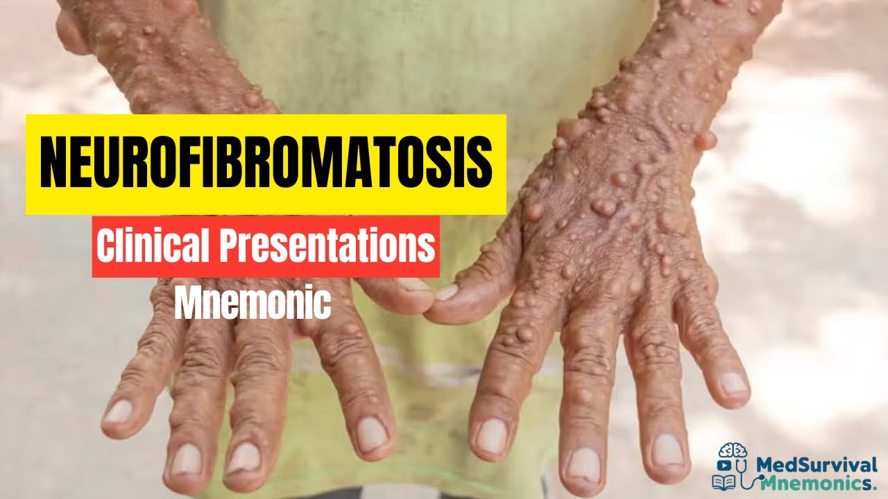 Neurofibromatosis Type 1: Easy Mnemonic to Remember!