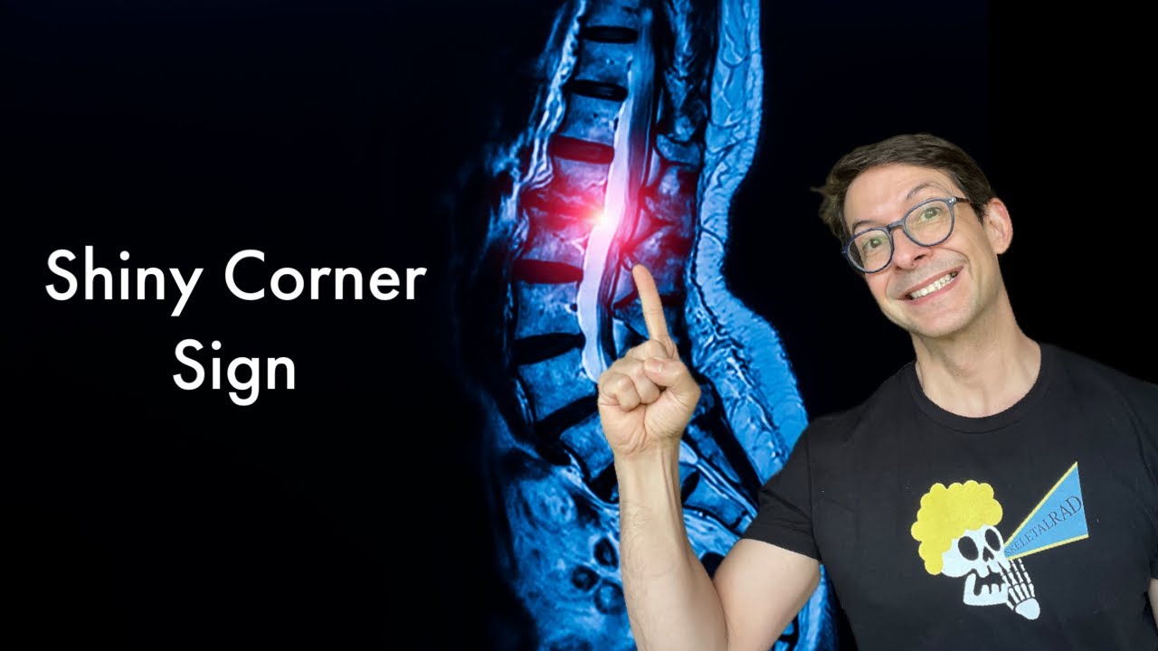 Shiny corner sign of Ankylosing Spondylitis