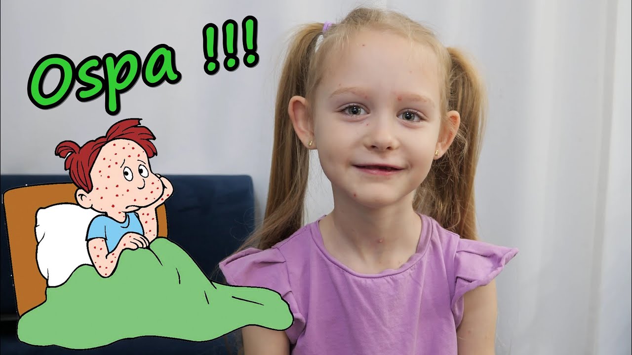 Zachorowała na ospę! 😱