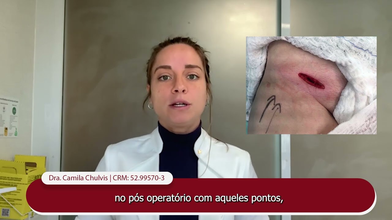 Pós operatório da Safena