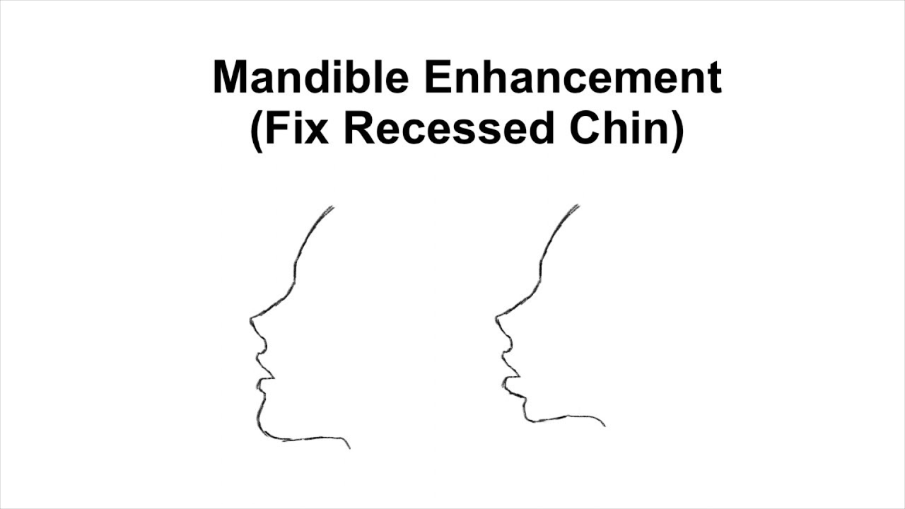 Mandible Enhancement / Fix Recessed Chin + V Shaped Face (Subliminal)
