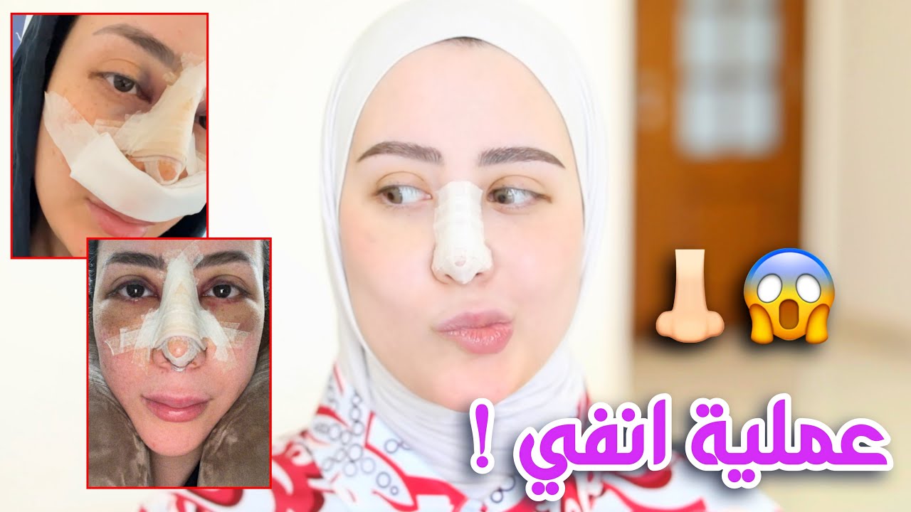 سويت عمليه لأنفي 😳 شوفوا شكلي كيف صار !! 