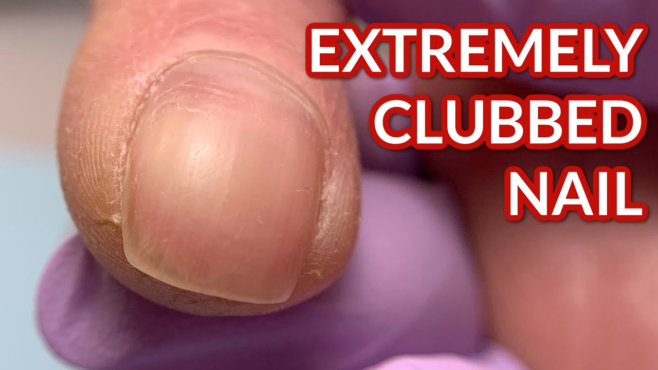 Clubbed Nail After Being Injured in The Train 🚊Accident | Transformation with Acrylic