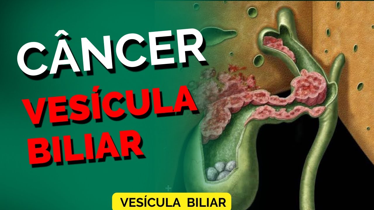 Sintomas do CÂNCER DE VESÍCULA BILIAR !!!