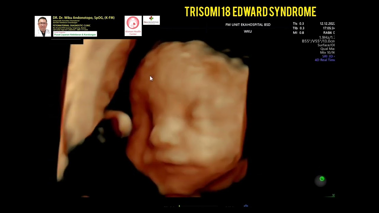 Edwards Syndrome T 18