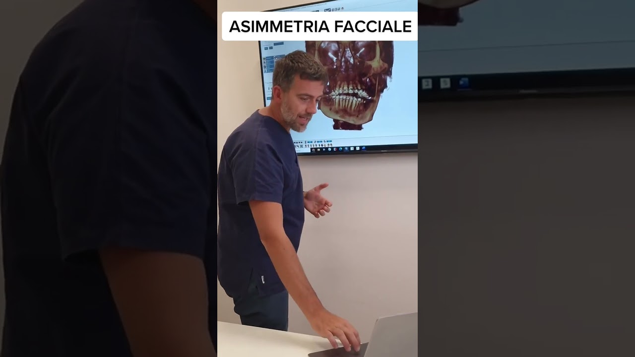 Asimmetria del viso, mento storto, faccia storta