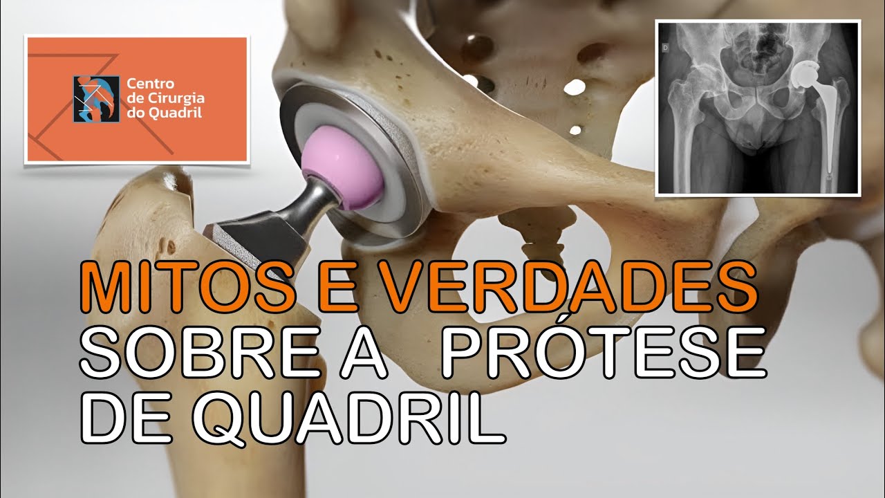 MITOS E VERDADES SOBRE A ARTROPLASTIA TOTAL DO QUADRIL