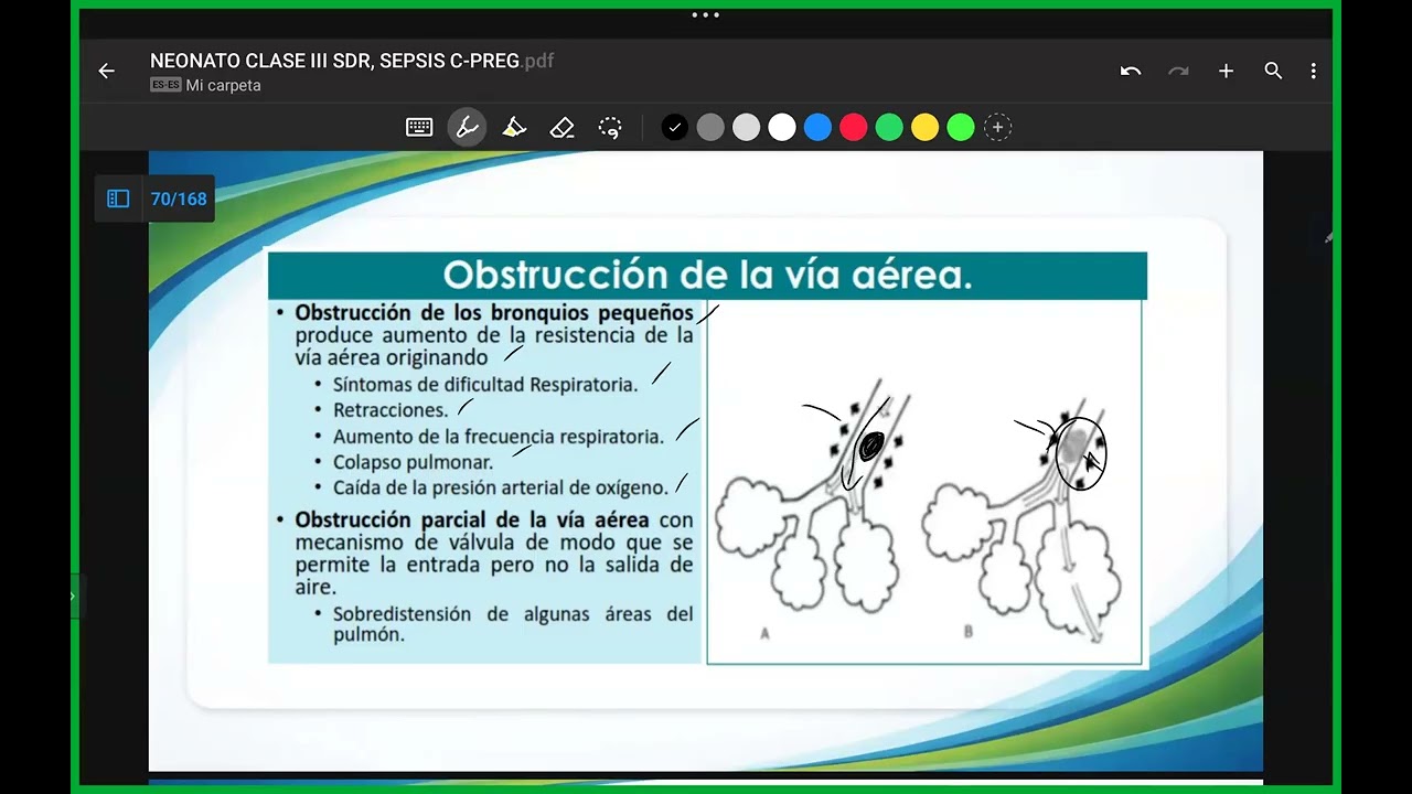 Neonato clase: SDR, sepsis neonatal 03