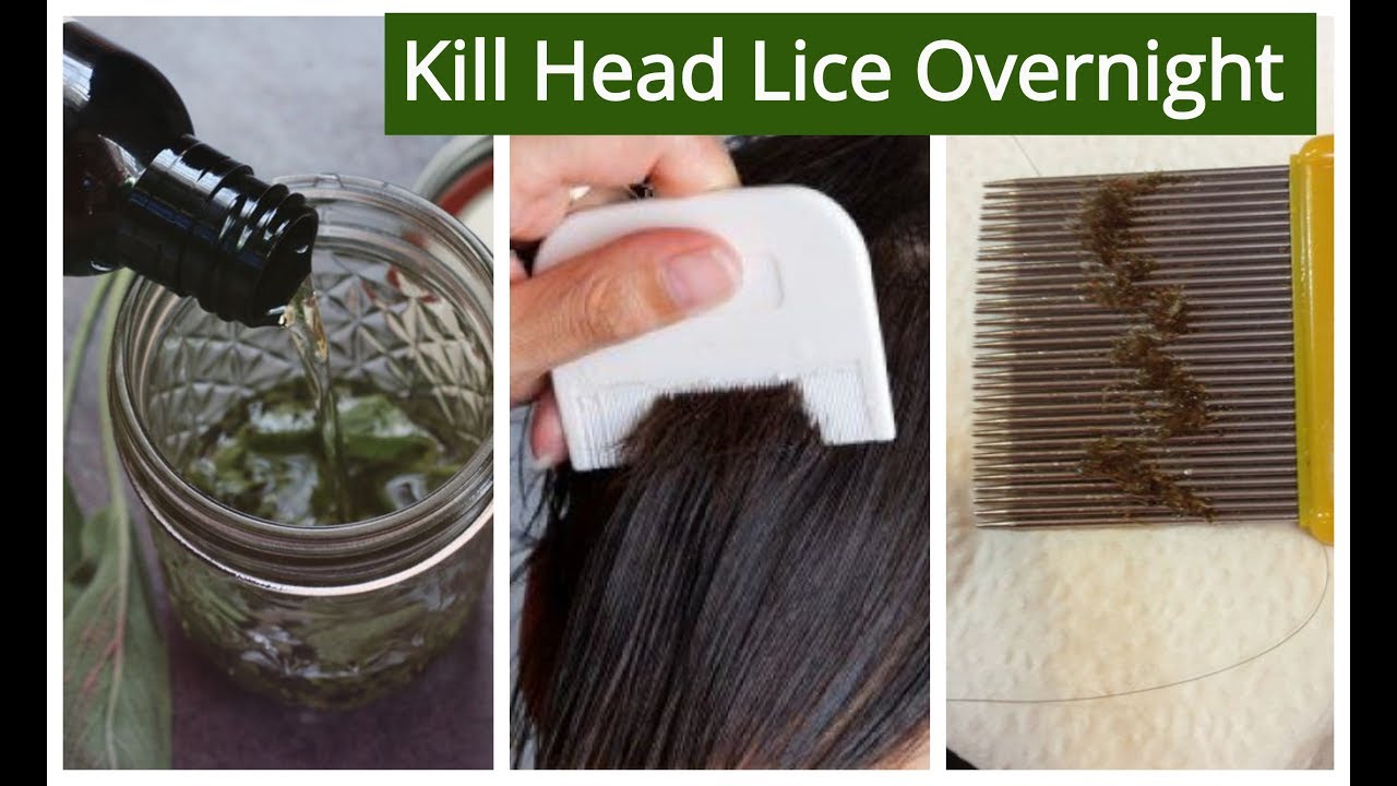 Homemade Hair OIL for Lice & Nits Removal | KILL HEAD LICE & NITS Overnight  | Sushmita's Diaries