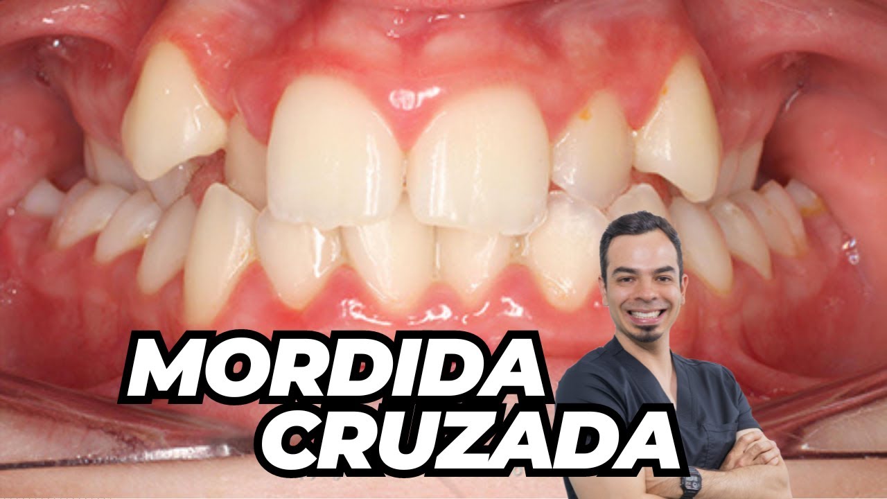 🚨LA MORDIDA CRUZADA POSTERIOR / EL PELIGRO ⚠️ DETRÁS DE ELLA 🚨
