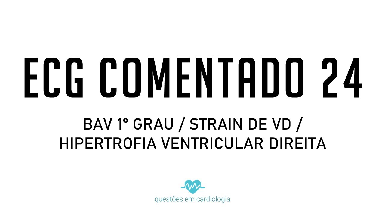 ECG comentado 24 - BAV 1° grau / Strain de VD / HVD