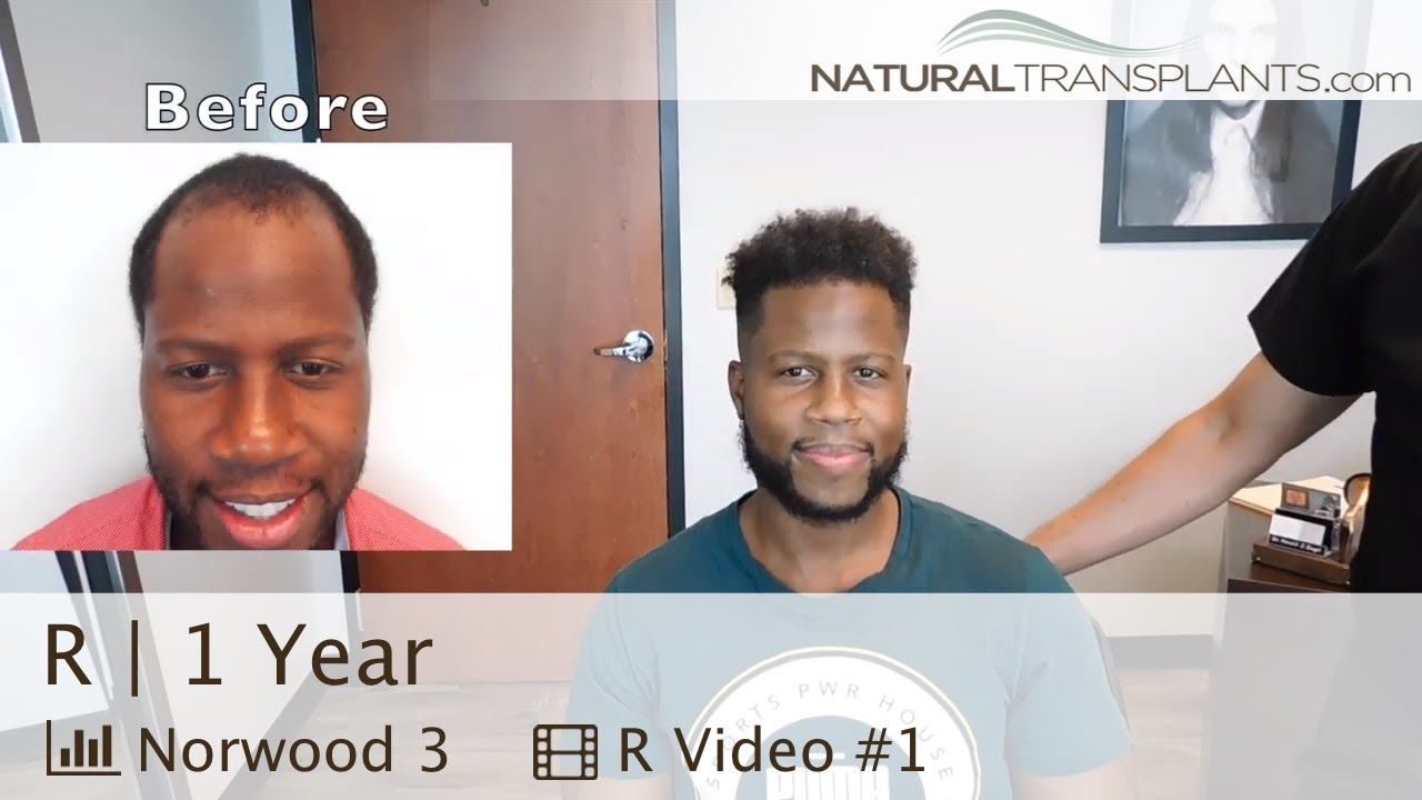 Male Frontal Baldness Hair Transplant Results 12 Months | Doctor Harold Siegel (R)