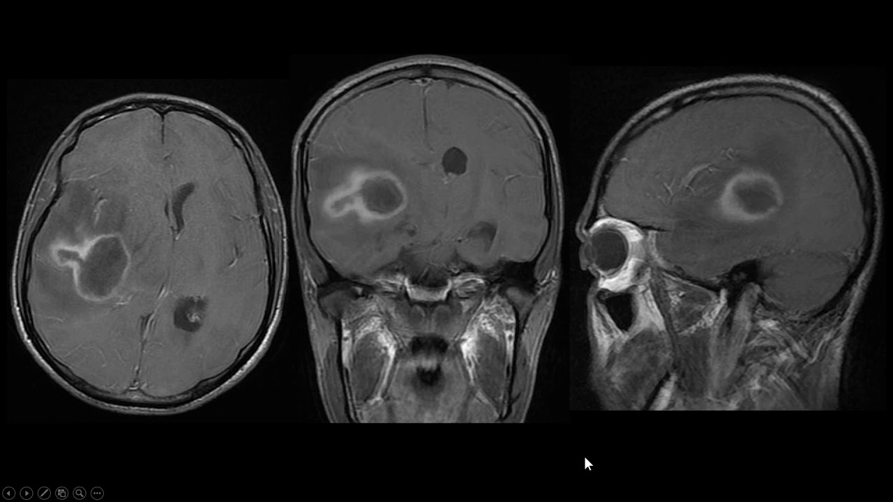 Abscesso cerebral