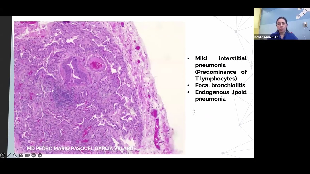 Anti-MDA-5 Dermato-Pulmonary Syndrome: Two Cases,  Different Outcomes