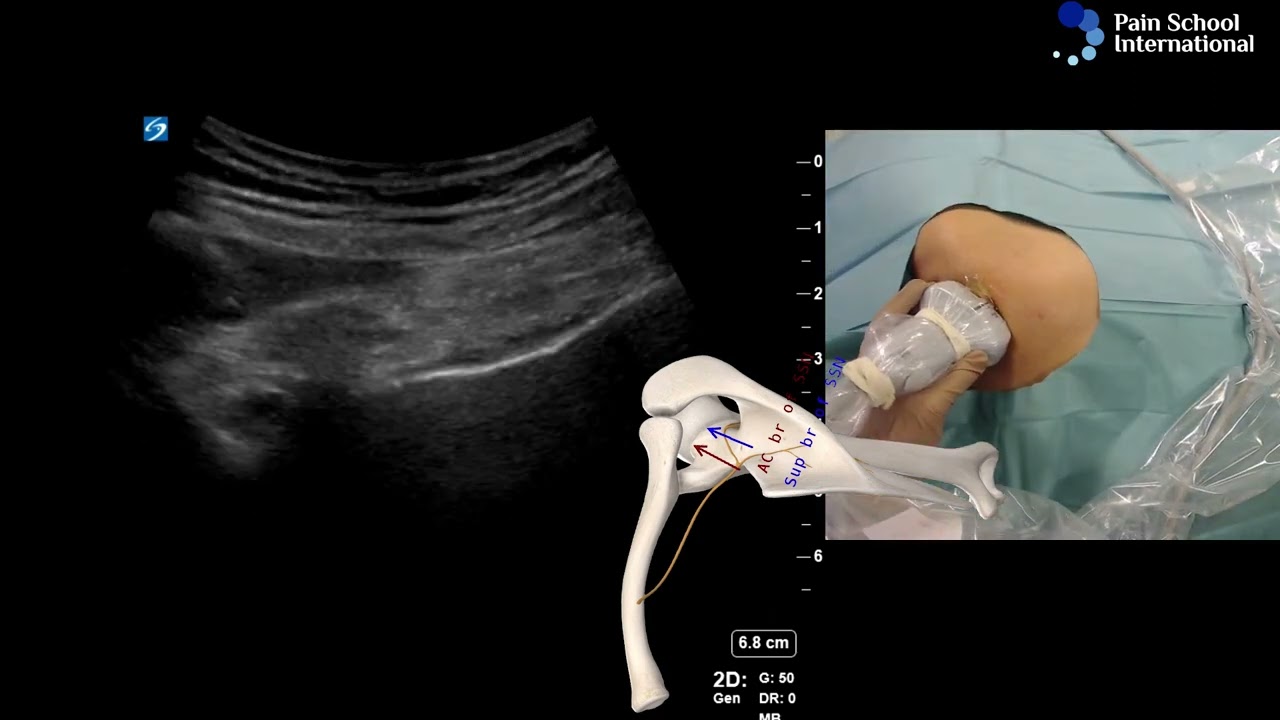 Dr Agnes Stogicza - Cryoablation E-Learning Seminar 1 Session 3: Shoulder Cryoablation