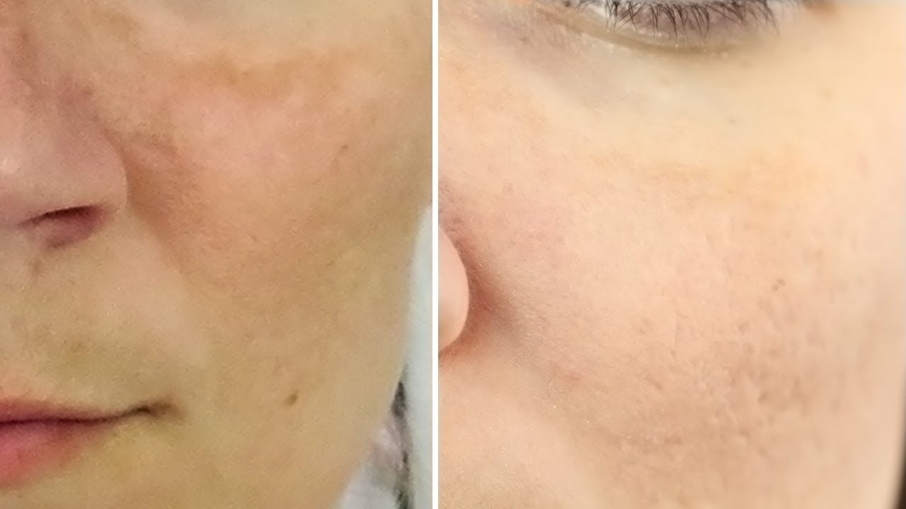 12 Heilmittel um Melasma zu behandeln!