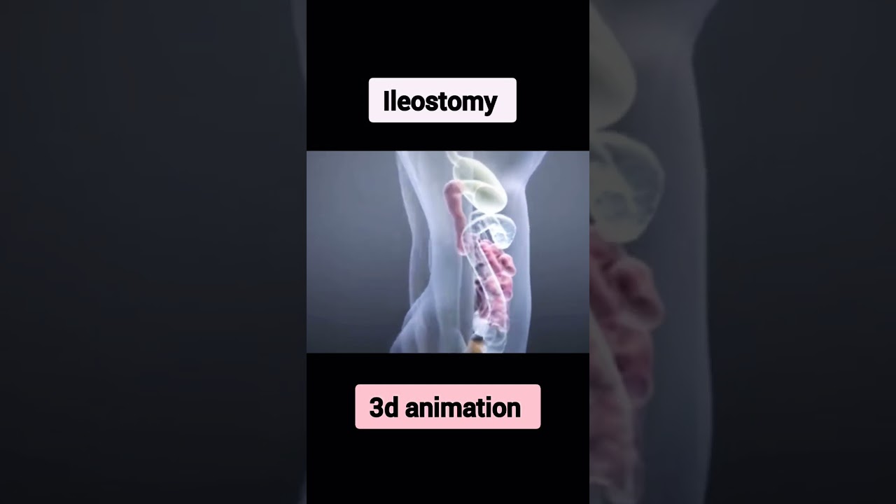 Ileostomy surgery 3d #shorts #medical #humanbody #3danimation #treatment #anatomy #surgery