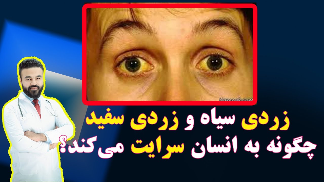 زردی سیاه و زردی سفید چگونه به انسان سرایت می کند؟! داکتر قیس نیکزاد