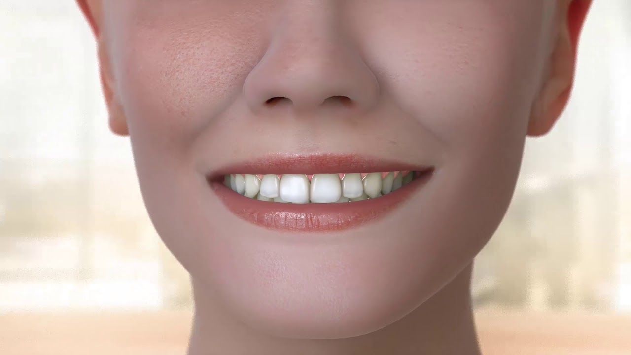 Molen Orthodontics - Bionator