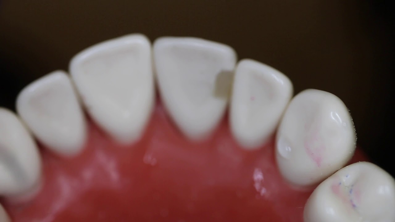 Class III Composite Placement, Finish, & Polish