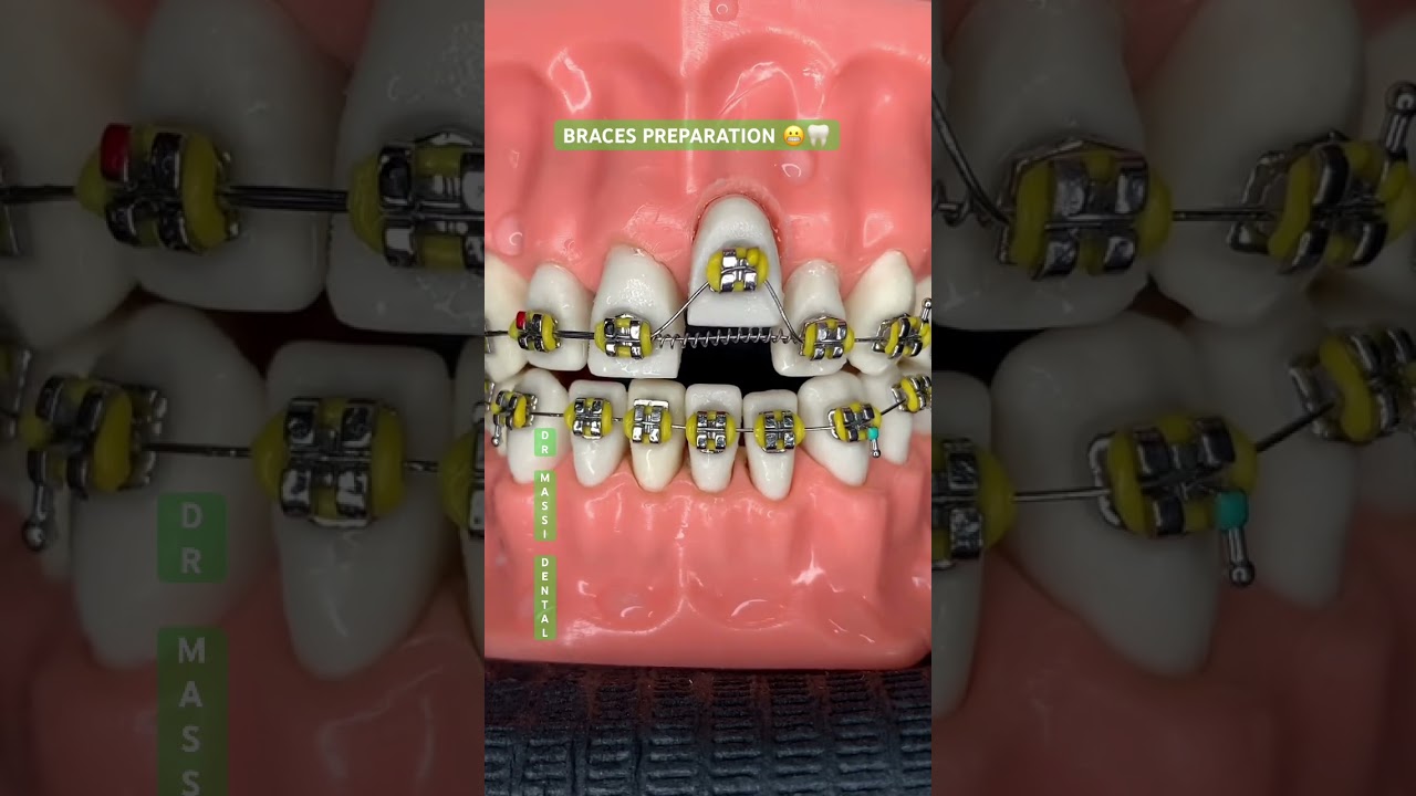ПОДГОТОВКА К УСТАНОВКЕ БРЕКЕТОВ 😬🦷