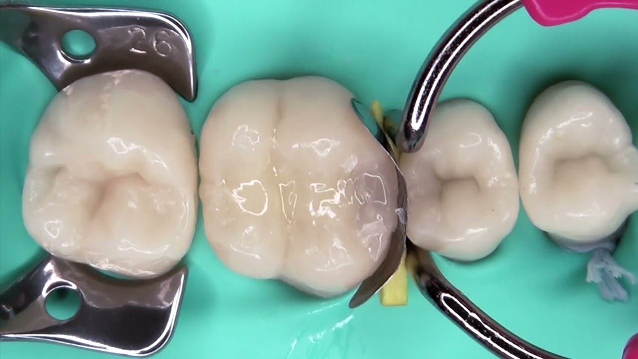 Ecosite BulkFill by DMG - Quality fillings in no time. Case by Prof. Leandro Hilgert
