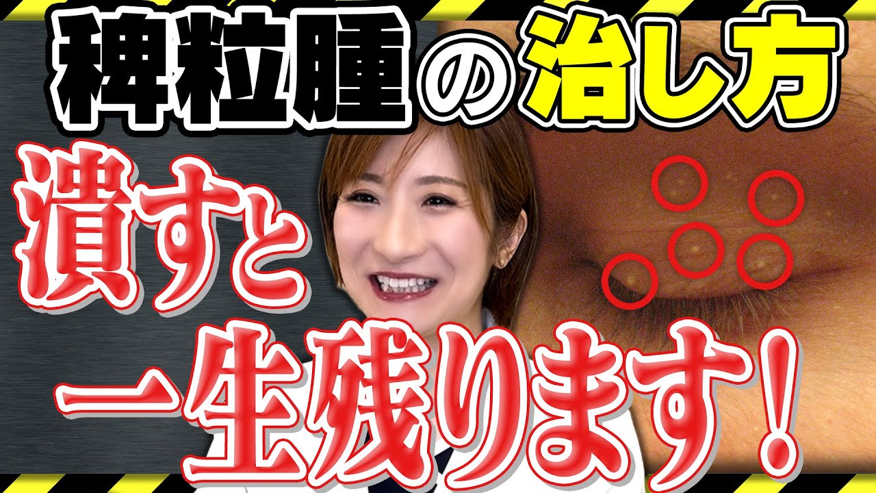 【稗粒腫】目の周りの白いブツブツの正体と治す方法について皮膚科医が解説