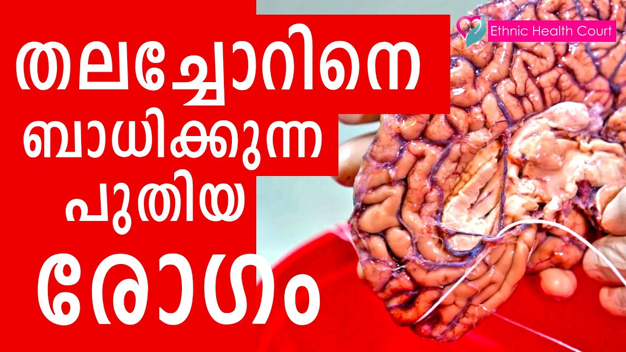 മരിച്ചുപോയവരെ കാണുന്ന അപൂർവ രോഗം | Rare brain disease - Seeing dead | Ethnic Health Court