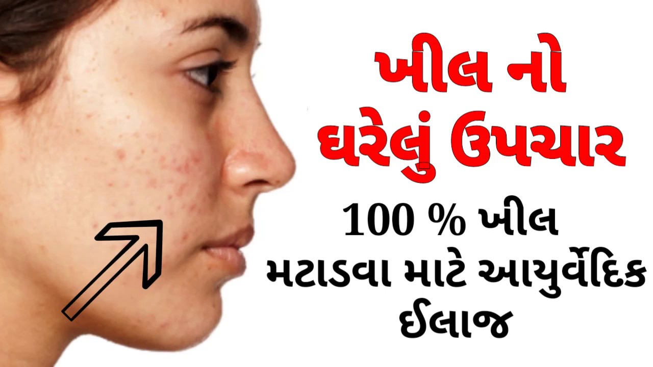 ખીલ મટાડવાના ઉપાયો | Khil Mate  na upay | #khilmateupay #gujaratiayurved #gujaratihealthtips
