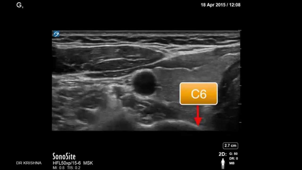 Stellate ganglion block under ultrasound by Dr Murli Krishna